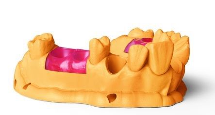 Демонстрационная модель челюсти с вставками из NextDent Gingiva Mask